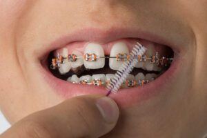 braces