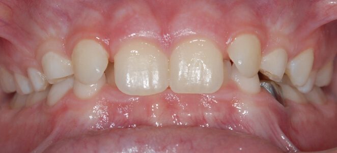 patient teeth before 9