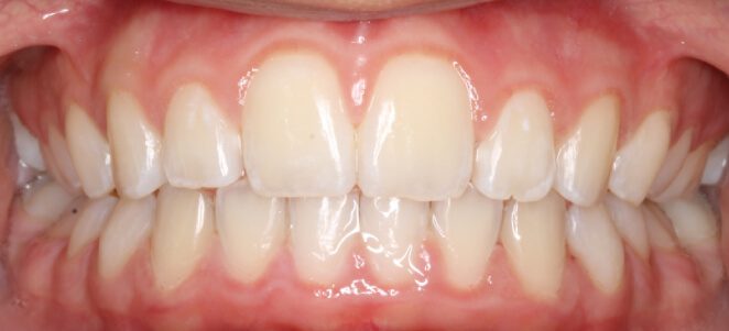 patient teeth after 12