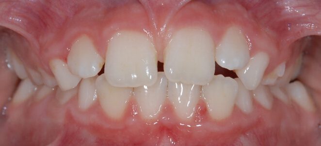 patient teeth before 3
