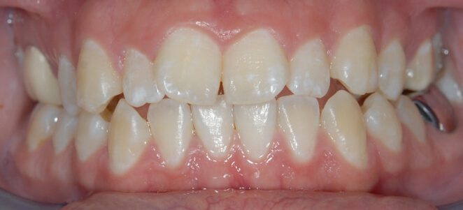 patient teeth before 6