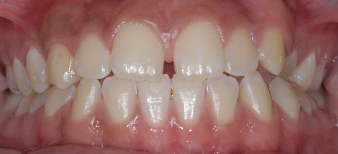 patient teeth before 7