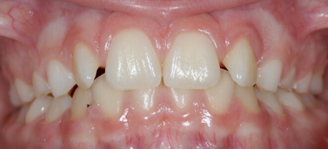patient teeth before 8