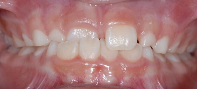 patient teeth before